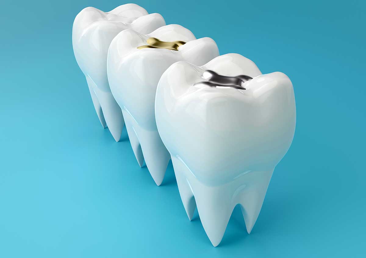 Dental Implants in Burbank