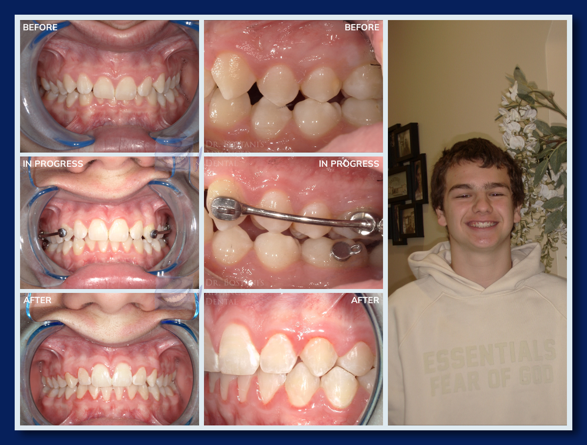 Orthodontics - Before & After Results 3