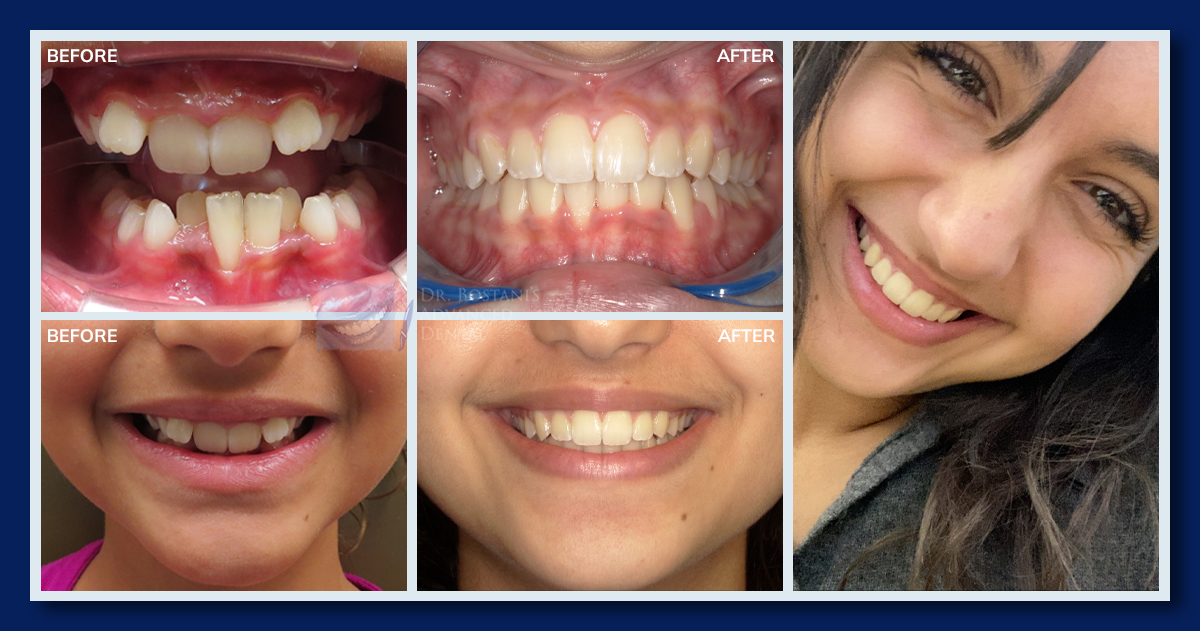 Orthodontics - Before & After Results 1