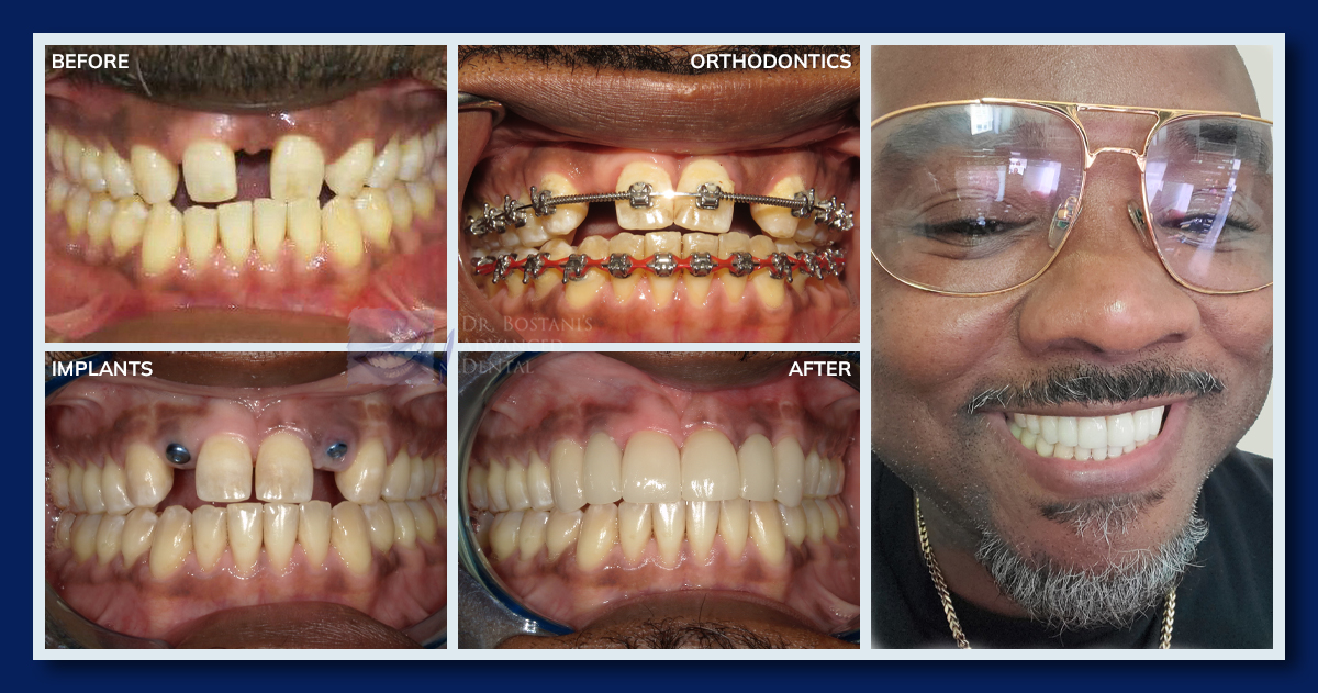Orthodontics, Implants, and Veneers - Before & After Results 1