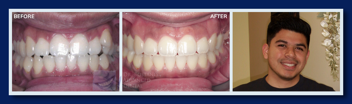 Orthodontics - Before & After Results 2